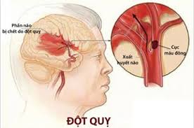 Món ăn bài thuốc dành cho người tai biến mạch máu não (Đột quỵ)