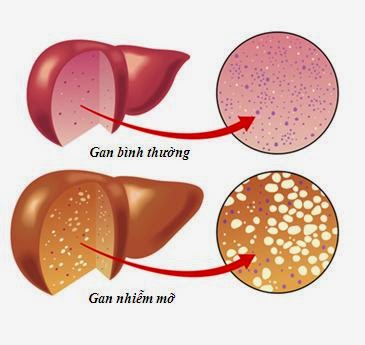 Cây thuốc dân gian trị Gan nhiễm mỡ