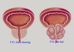 Thực phẩm giúp ngừa ung thư tuyến tiền liệt