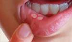 Đông y trị nhiệt miệng
